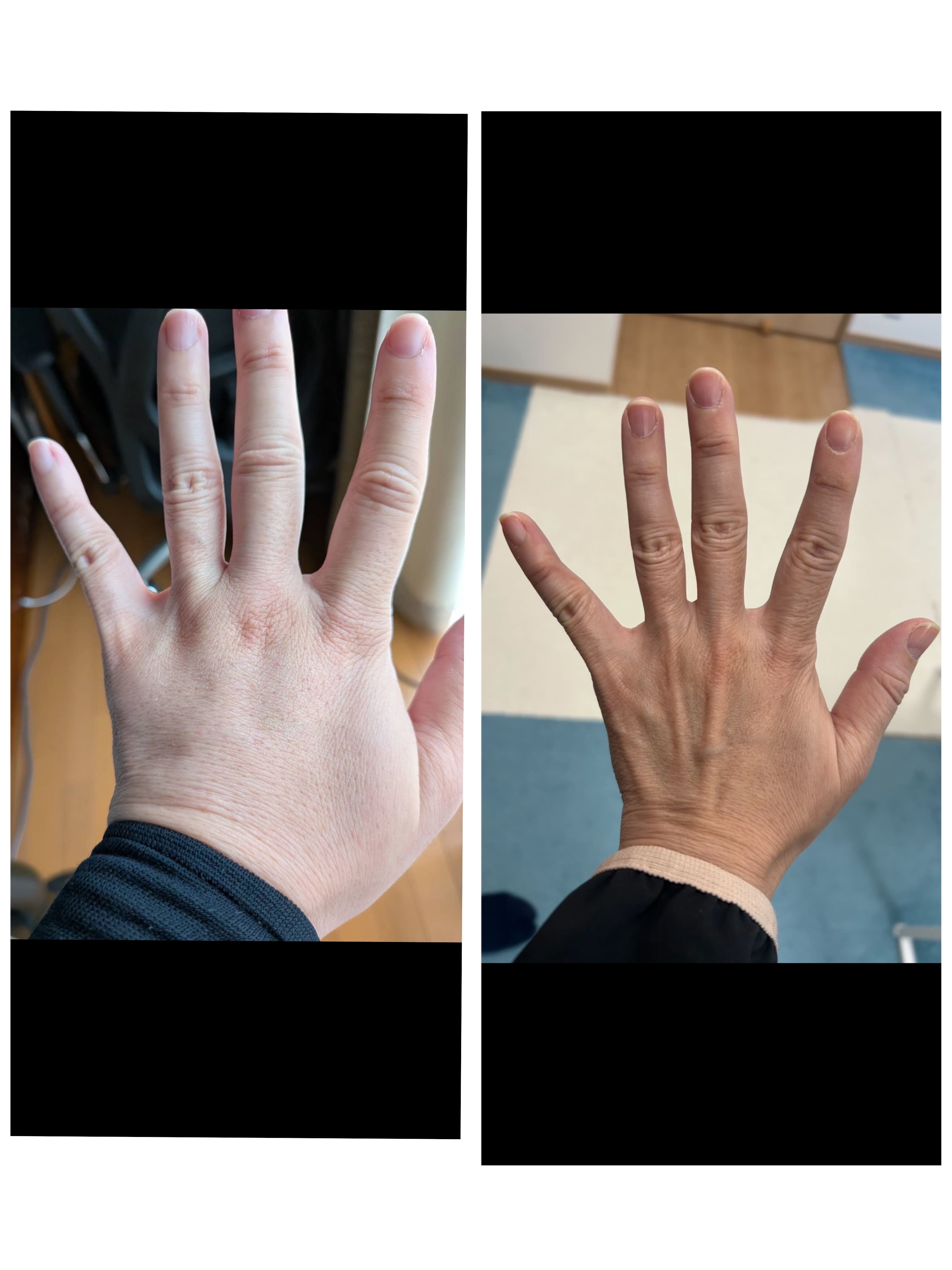 乳がんの手術後のリンパ浮腫の施術事例