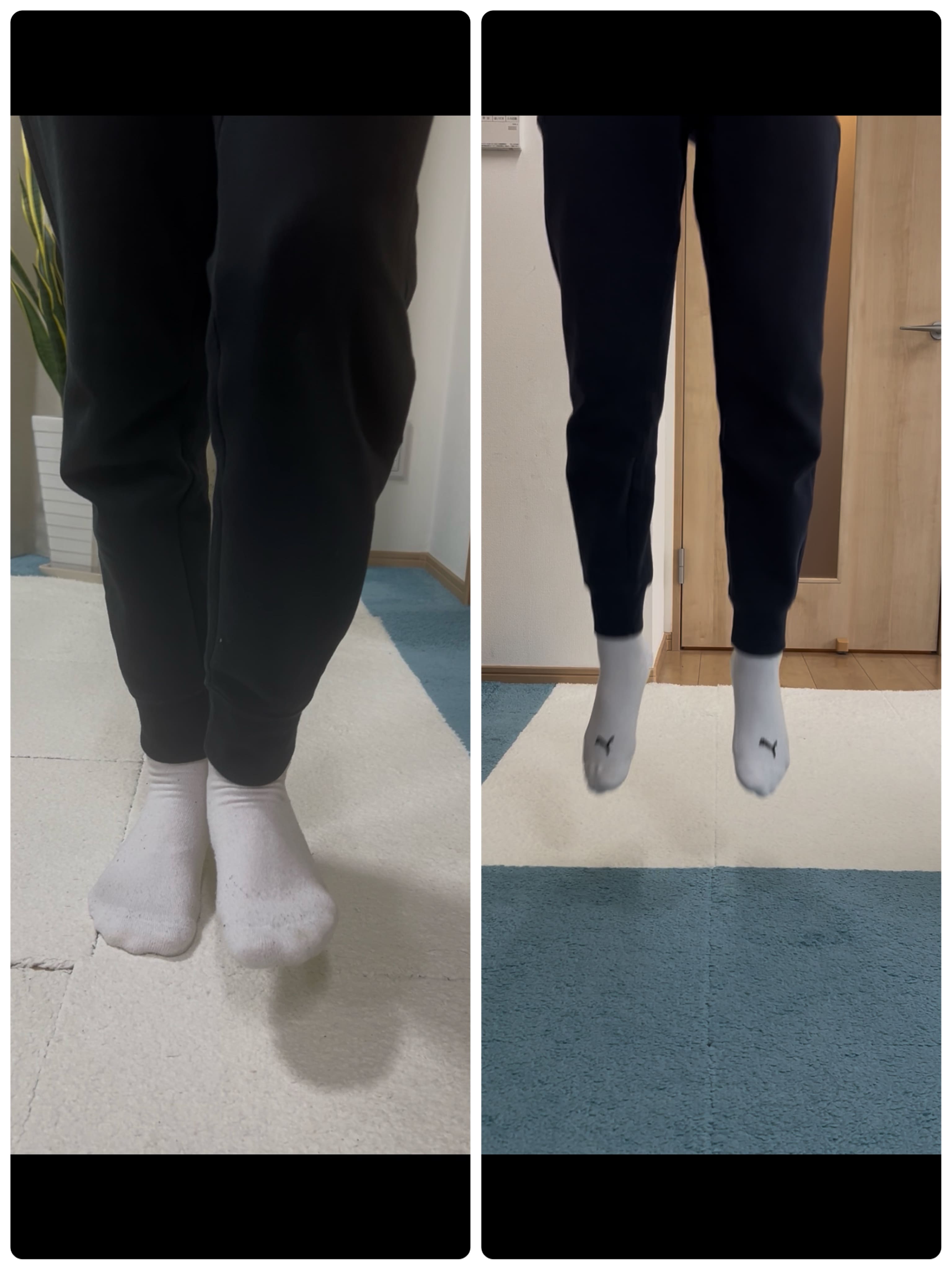 シンスプリントの施術事例